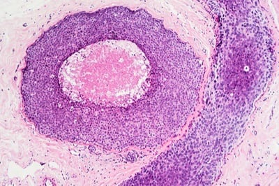 Cellular diversity in tumors may predict survival for some types of breast cancer
