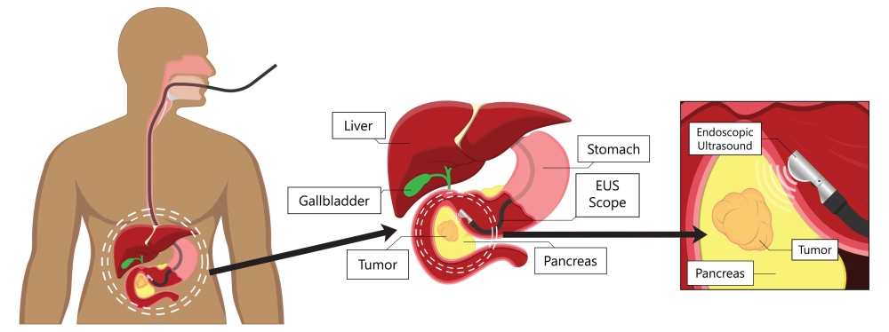 Graphic of endoscopic <button
                x-data
                class='glossary-tip tt-ultrasound'
                x-tooltip='<p>Also known as a sonogram, ultrasound is a device that&nbsp;uses sound to see images of internal organs and&nbsp;look for abnormalities in the body. Ultrasounds are sometimes used along with other methods to diagnose breast, ovarian, and pancreatic, and prostate cancers. Ultrasounds may also be used to diagnose pregnancy or conditions such as heart disease.</p>
'
            >ultrasound</button> procedure