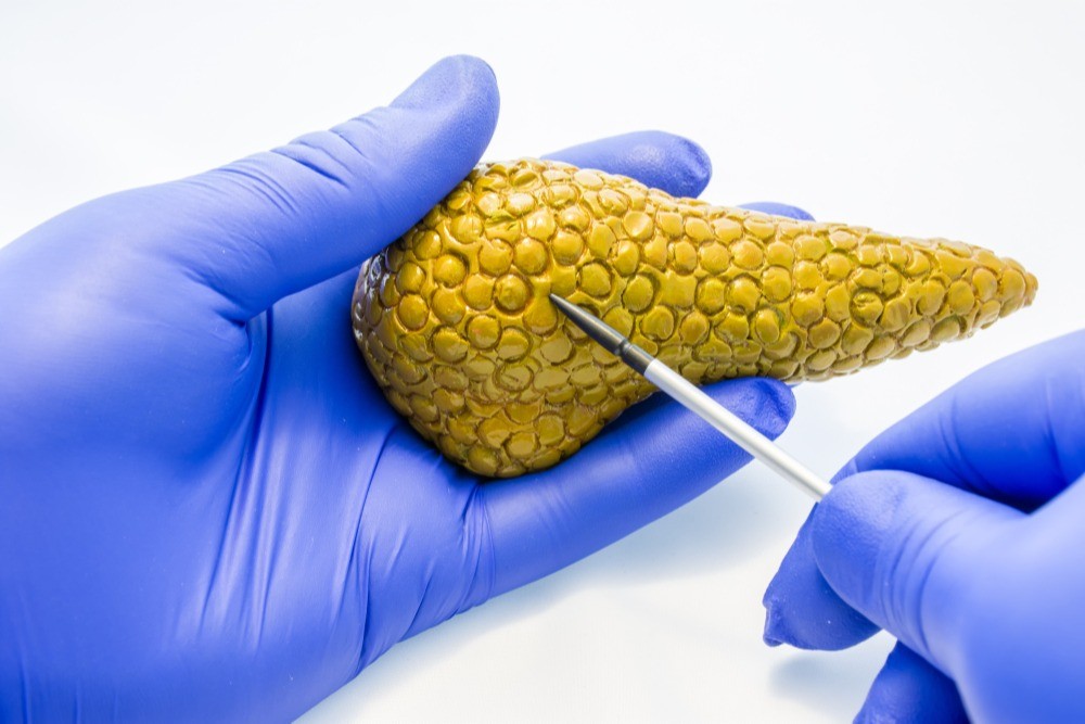 This reviews current treatments and approaches for pancreatic cancer.