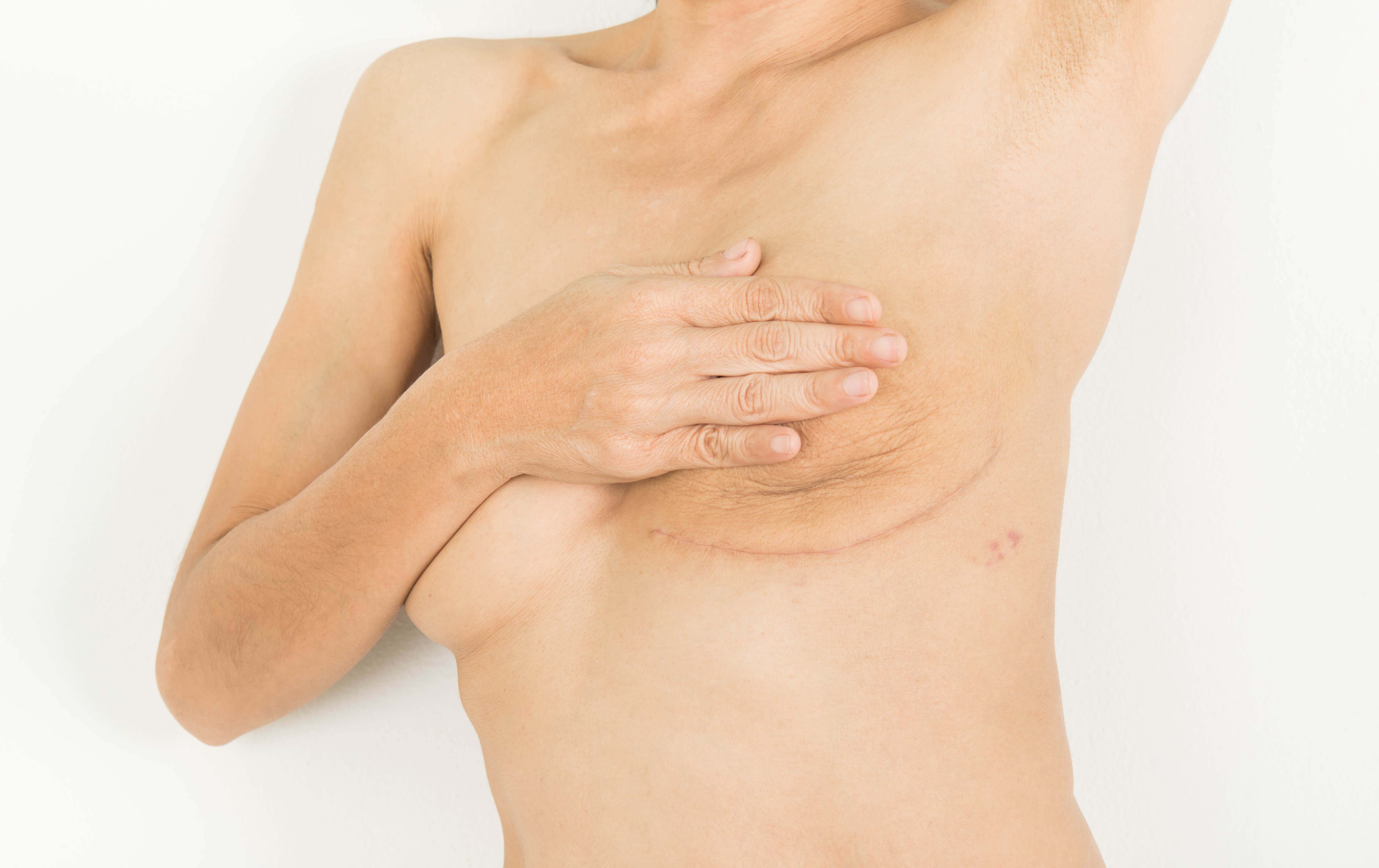 reconstruction is not the only post mastectomy option