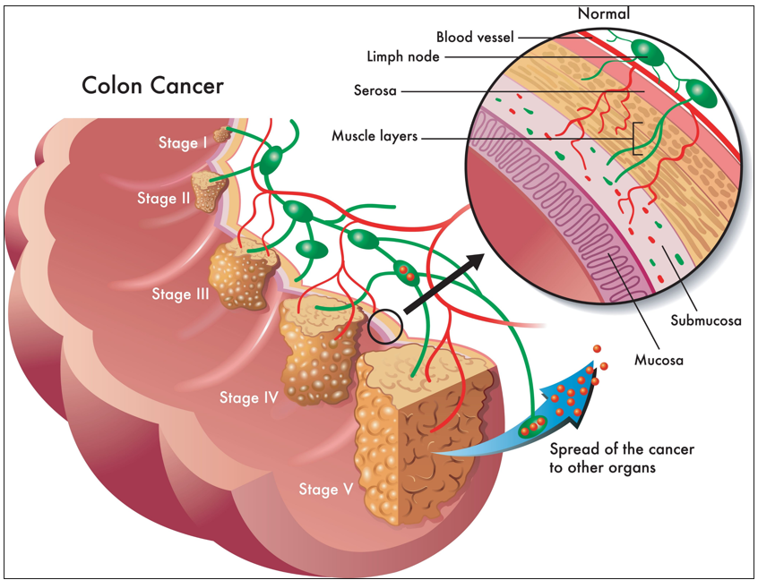 Colon Cancer Stage 4
