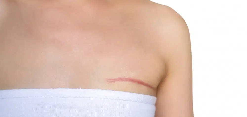 My BRCA2 Story: Mastectomy Without Reconstruction
