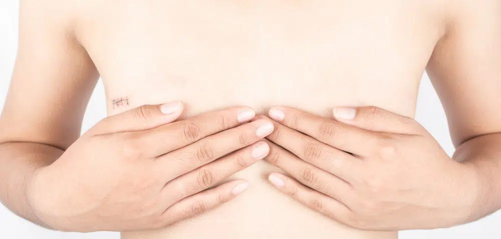 Voices: Mastectomy Without Reconstruction A Very Personal Choice