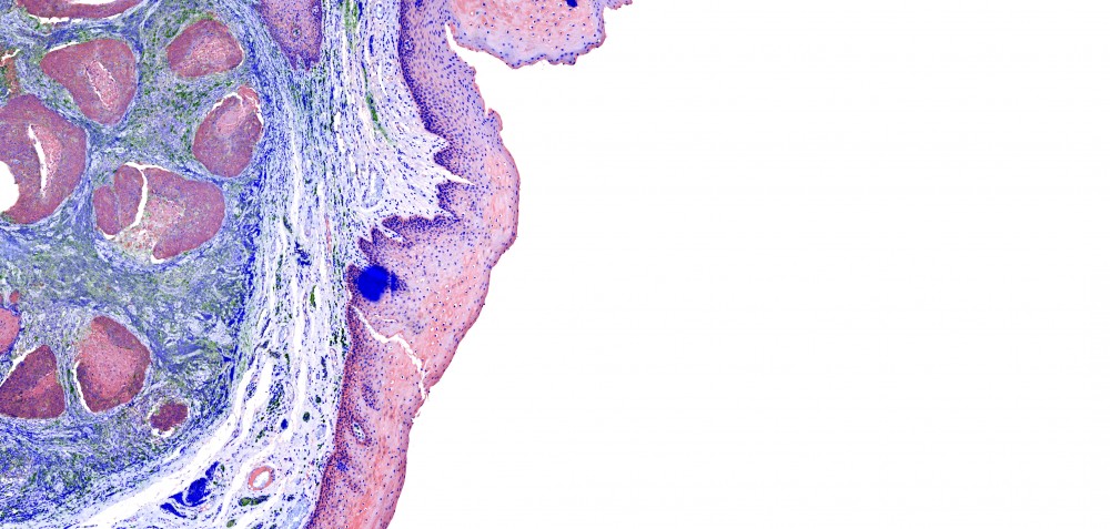 Voices: Pancreatic Cancer Screening