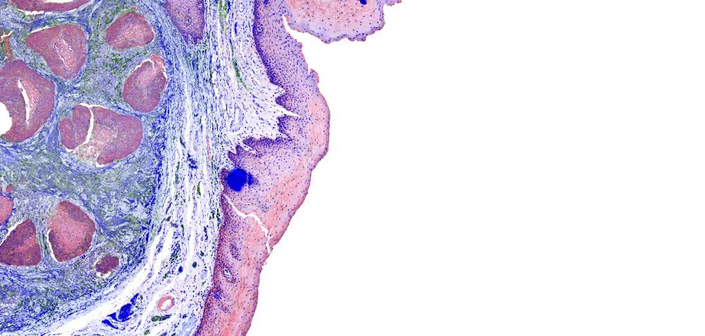Voices: Pancreatic Cancer Screening