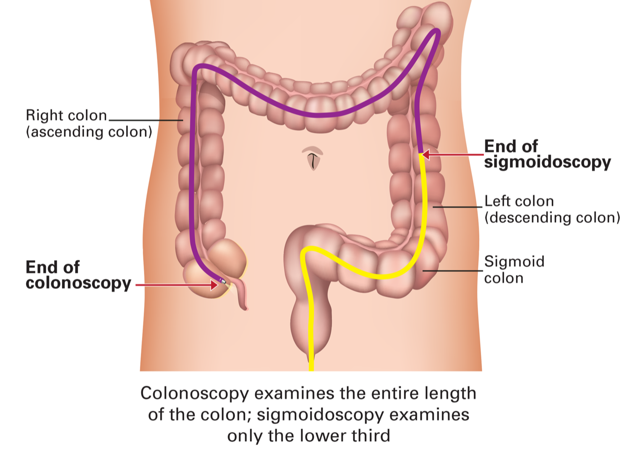 Image of colon showing how much of the colon can be seen by sigmoidoscopy compared with colonoscopy