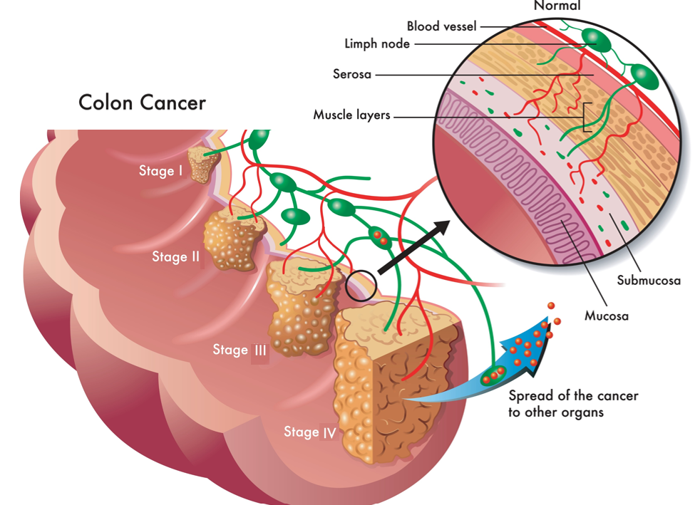 Illustration of the stages of colon cancer