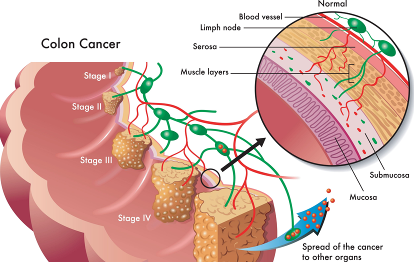 colon cancer stage 0