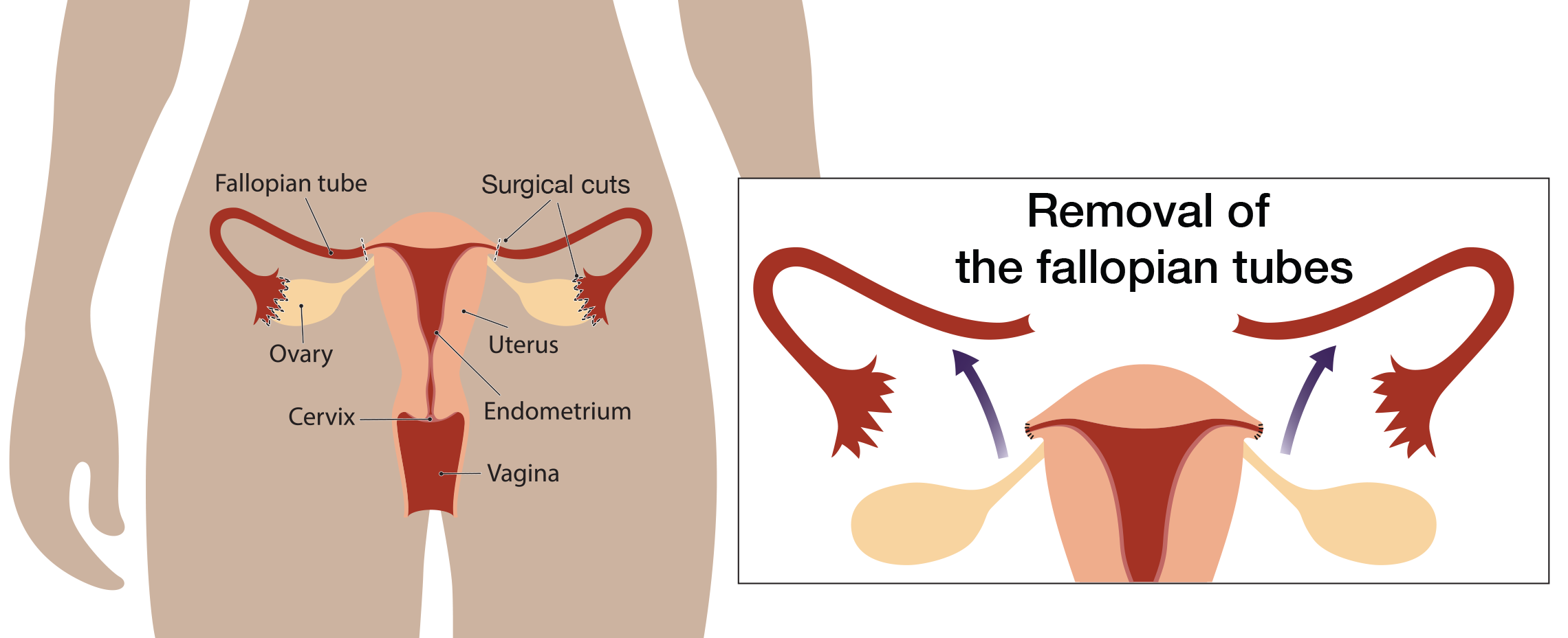 Graphic image of female reproductive tract and what is removed during <button
                x-data
                class='glossary-tip tt-salpingectomy'
                x-tooltip='<p>Removal of the fallopian tubes.</p>
'
            >salpingectomy</button> surgery